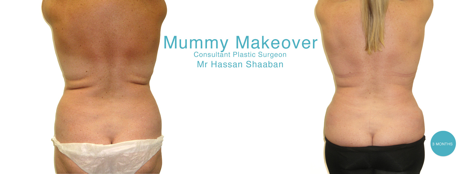mummy makeover before and after photographs surgical procedures performed in Liverpool by  Mr Hassan Shaaban